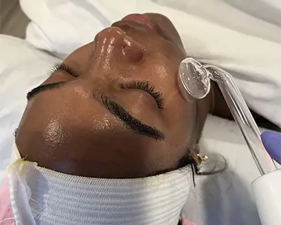 Microdermabrasion, Teaneck, NJ